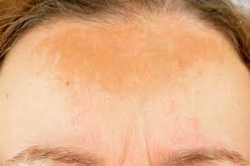 Image result for Melasma
