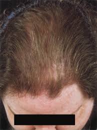 Hair loss is most commonly caused by a condition called 'pattern hair loss' and this primarily affects the top and front of the scalp; Hair Loss In Women With Hyperandrogenism Four Cases Responding To Finasteride Sciencedirect