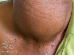 Check spelling or type a new query. How To Tell A Lump From A Lymph Node