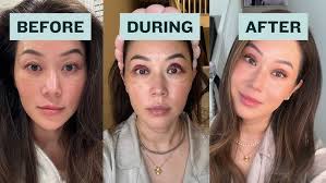 What Are Nasolabial Folds?