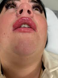 Staznis has decided to carry