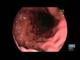 Diagnosis And Grading Of Sliding Hiatal Hernia Youtube