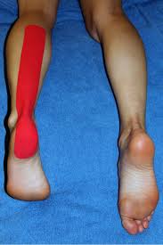 Image result for Taping for Soleus and Achilles