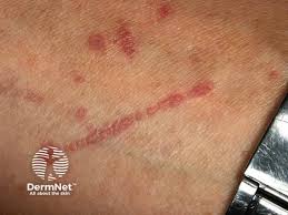 Image result for koebner phenomenon psoriasis