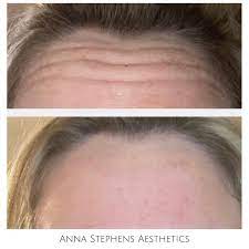 Discover in ruston from anna stephens aesthetics today. Facebook