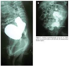 Image result for Voiding Cystourethrogram