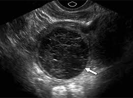 Image result for corpus luteum sonography)