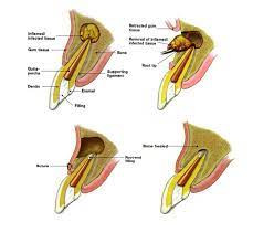 Apicoectomy Dentagama Dentistry Dental Dental Student