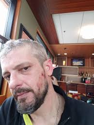 I will never try to break up a fight again. Especially when one of the  participants is holding a big thick branch! For this is the fourth time  this year that I