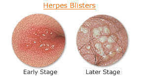 Hsl (hue, saturation, lightness) and hsv (hue, saturation, value, also known as hsb or hue, saturation, brightness) are alternative representations of the rgb color model. Herpes Homeopathic Treatment I Understand Symptoms Remedies And Medicine