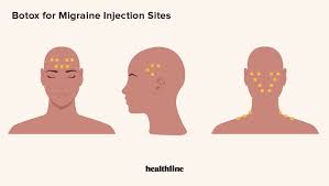 Botox injections block certain chemical signals from nerves, mostly signals that cause muscles to contract. Does Botox Help Treat Chronic Migraine