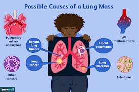 A new cough that doesn't go away coughing up blood, even a small amount Primary And Secondary Lung Cancer