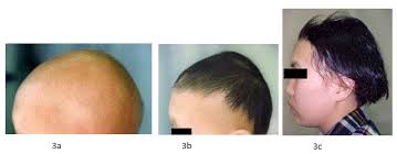 Recently i have noticed a lot of facial hair and acne. Herb Lotions To Regrow Hair In Patients With Intractable Alopecia Areata