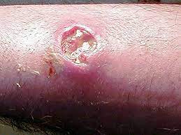 Deadly Skin Infection? 12 Graphic Photos That Could Save Your Life