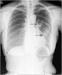 Image result for Air Bronchogram