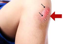 Image result for Skin Trauma