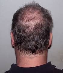 The thyroid is a gland found in the neck, responsible for creating and releasing hormones throughout the body. Hair Loss Causes Hair Transplant Center Houston Hair Transplant Dr Jezic