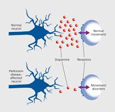 Parkinson's disease is neurodegenerative, the second most common disorder of this type after alzheimer's disease. P H A R M A C O N N E C T On Twitter Pathophysiology Of Parkinson S Disease Https T Co Obwweiw3wb