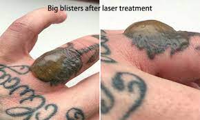 Why do i get blisters from laser tattoo removal? Laser Tattoo Removal Aftercare Blisters 11 Proven Solutions 2019 Vivalaser
