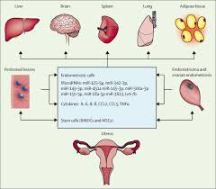 The novel is under the editing process. Endometriosis Is A Chronic Systemic Disease Clinical Challenges And Novel Innovations The Lancet