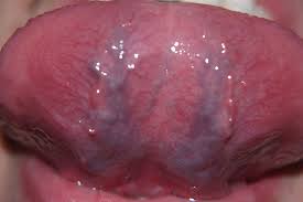 Image result for black tongue symptoms
