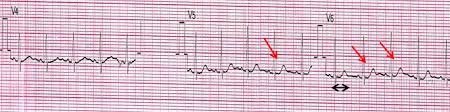 Jillian hessel is an internationally renowned master pilates teacher based in los angeles, california. Validation Of Corrected And Dispersed Qt As Predictors Of Adverse Outcomes In Acute Cardiotoxicities Springerlink