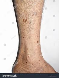 Image result for liver spots on legs