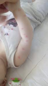 vucutta kasinti ve kabarciklar neden olur kasinti ve kabarmalar nasil gecer saglik haberleri