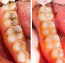 How long does it take to fill a surface cavity. Everything You Need To Know About White Fillings