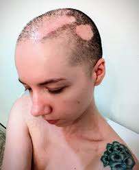 I Have A Rare Form Of Alopecia Called Cicatricial Alopecia. This Causes  Burning, Itching, Stinging, Pins/Needle Sensations, And Even Bleeding From  The Scalp. These Photos Show My Scalp After A 1 Hour