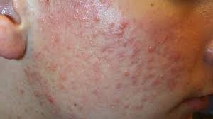 They may also look similar to those of acne. Raised Skin Bumps Pictures Types Causes And Treatment