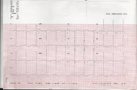 1,700 likes · 2 talking about this. Miocardiopatia Hipertrofica Cardiomap