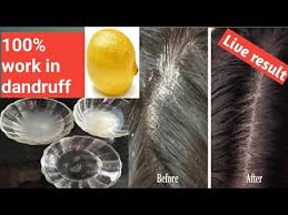It is seen either due to dry scalp pr due to over oily scalp. How To Remove Dandruff In One Wash How To Get Rid Of Dandruff In One Wash Scalp Dandruff Removal Youtube