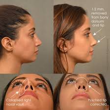 Changesplasticsurgery Rhinoplasty Rhinoplasty Corrections Collapsed Revision Nostril Dorsum Right And Nonsurgical Nose Job Nose Job Nose Contouring