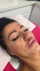 Microneedling
