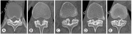 The ligamentum flavum forms a cover over the dura mater: Sato Classification According To The Progression Of The Ligament Download Scientific Diagram