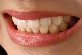 Maybe you would like to learn more about one of these? Are Veneers Helpful In Fixing Overbite
