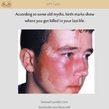 Birthmarks Are Where You Were Killed Rofl If Thats True I Died Because Someone Stabbed Me In The Elbow Weird Facts Birthmark The More You Know