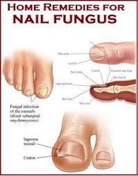 Home Remedies For Nail Fungus Tea Tree Oil Baking Soda Peroxide Coconut Oil C Blog Nail Fungus Remedy Toenail Fungus Remedies Toenail Fungus