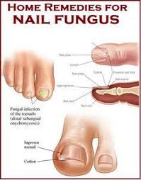 Toenail fungus, also known as onychomycosis, is perhaps one of the most common nail disorders. Home Remedies For Nail Fungus Tea Tree Oil Baking Soda Peroxide Coconut Oil C Blog Toenail Fungus Remedies Nail Fungus Remedy Toenail Fungus