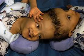 They are known to have very different personalities. Joined At The Head Famous Craniopagus Twins Cbc Docs Pov
