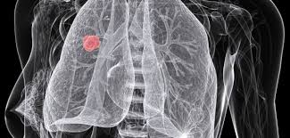Image result for lung cancer xray