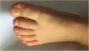 Image result for Beau lines feet