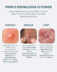 Image result for Pustule