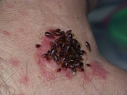 Image result for bedbug bites look like