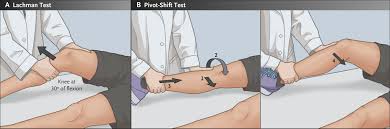 Image result for Lachman Test