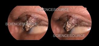 Image result for cornu cutaneum)