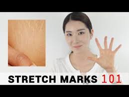 5 Essential Tips For Stretch Marks Wishtrend Youtube Stretch Marks Beauty Secrets Oils For Skin