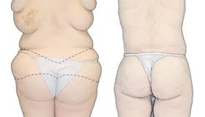 Fat with cellulit before and slim tight after. Butt Lift Procedure Skin Tightening Dr Rodriguez Cosmeticsurg Baltimore