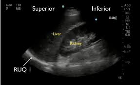 Right kidney and adrenal gland; Right Upper Quadrant Fast View Showing Hepato Diaphragmatic Space Download Scientific Diagram